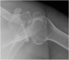 Shoulder Posterior Instability Glenoid Retroversion